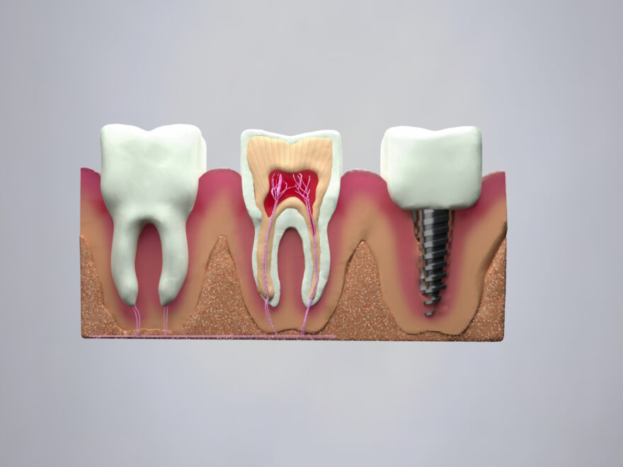 インプラントと歯の違い
